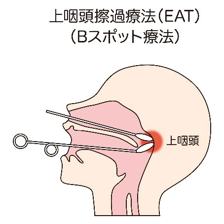 Bスポット治療